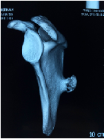 An Unusual Presentation of Osteochondroma on the Dorsal Surface of the Scapula- A Review of Literature