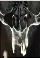 What Surprises Lie Beneath a Panoramic Radiograph in Dental Implant Planning