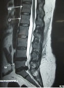 Correlation of Canal Dimension with Neurological Status and Surgical Outcome in Lumbar PIVD