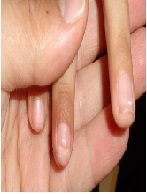 Simple Approach. Beautiful Outcome in Nail Bed Repair in Pediatric Patients