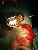 Dyphillobothrium Intestinal Obstruction