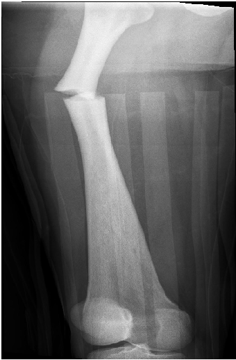 Toulouse-Lautrec Disease: A Case Report of a Femur Shaft Fracture