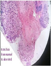 Ectopic Pancreas in Stomach: An Incidental Finding in A Trauma Patient, A Case Report with Review of Literature