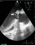 Ralstonia pickettii-Infected Endocarditis Complicated with Possible Septic Emboli in Kidney: A Rare Case Report