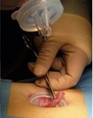 Single Port Laparoscopic Appendectomy for Chronic Right Lower Quadrant Pain in Children