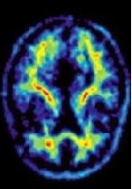 Alzheimer’s Disease: New Treatment Perspectives Involving Active and Passive Immunotherapy
