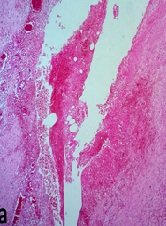 Didelphys Uterus Associated to Ipsilateral Vaginal and Renal Agenesis in Mother of Two Kids: Unusual Case Report