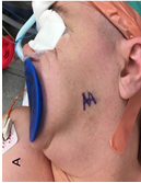 Optradam, a Dentist Tool, Utilized for Proper Jaw Manipulation During TMJ Arthroscopy and Arthroplasty