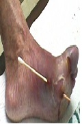 The Wound Evaluation- A Necessary Condition for Diabetic Foot Ulcer Approach- Key Notes