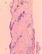 The Critical Role of Epidermal Stem Cell in Diabetic Foot Ulcer