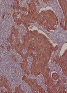 HER2 Breast Cancer Group in Morocco. A Pathological and Statistical Study