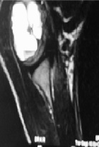 Is Fluid- Fluid Level in Osseous Lesions- A Diagnostic Clue?