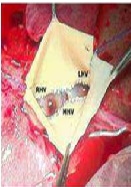 A New Cavoplasty in Domino Liver Transplantation for Familial Amyloidotic Polyneuropathy Using Arterial Donor Graft