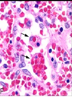 Hemophagocytic Lymphohistiocytosis: Overlooked in Critically Ill Adults?