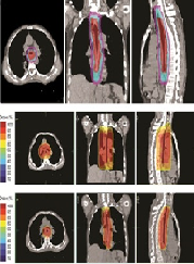 Optimal Dosimetry Study of Metal Stent with Three-Dimensional Conformal and Intensity Modulation Radiotherapy for Locally Advanced Esophageal Carcinoma
