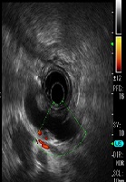 Pancreatic Duct Drainage Using EUS-Guided Rendezvous Technique for Dilated Pancreatic Duct due to the Stenosis of Anastomotic after Pancreaticogastrostomy: A Case Report