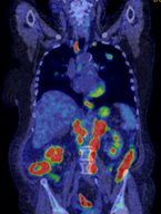 Atypical Presentations of Lung Cancer: A Case Series