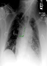 Combination of Unfractionated Heparin (UFH) and Triple Antiplatelet Therapy After Percutaneous Coronary Intervention (PCI) May Increase the Risk of Life Threatening Hemothorax in a Patient with Recent Rib Fracture
