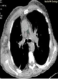 A Combination of Hodgkin's Lymphoma and Tuberculosis occurred with Bilateral Malignant Pleural Effusions