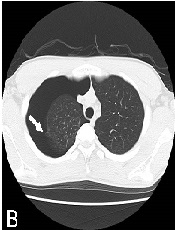 Concurrent Operation Revealing Concurrent Spontaneous Pneumothoraces in Monozygotic Twins within 24 Hours