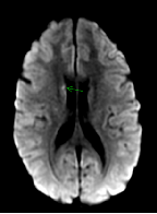 A Case of Synthetic Cannabinoid Induced Ischemic Stroke in A 20 Year Old Female