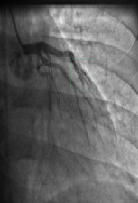 Marijuana Induced Coronary Vasospasm