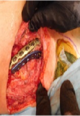 Treatment of Recalcitrant Medial Clavicle Non-union with Novel Dual Plating Technique