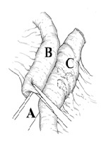 Intracorporeal Functional End to End Anastomosis Versus Overlap Anastomosis in Laparoscopic Right Hemicolectomy for Cancer: A Single-Center Study