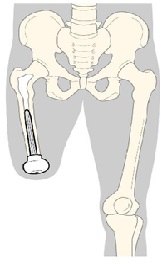 Evaluation of Functional Health and Well-Being In 23 Transfemoral Amputees After Distal Weight-Bearing Implant