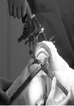 Intraoperative Joint Gap in Cruciate-Retaining Total Knee Arthroplasty