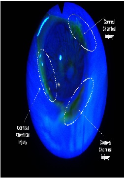 Cannabinoid Receptor CB1 Activation In Vivo Leads to Corneal Wound Healing After Chemical Injury, via Specific Receptor Vanilloid TRPV1 Desensitization