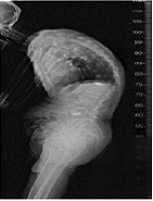 Successful Lightwand-Guided Intubation in a Patient with Long Standing Ankylosing Spondylitis Who Had Failed Intubation with Other Intubation Tools