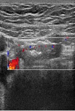 A Rare Case of Simultaneous Ectopic Pregnancy and Appendicitis as “Shouldn’t Miss” Diagnoses