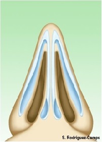 Rhinoplasty. A New Technique to Treat the Extremely Difficult Nasal Tip. Total Resection of the Alar Cartilages and Temporal Fascia. A 31-Year Experience