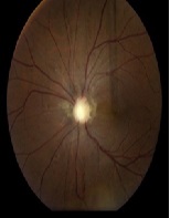 Ocular Findings and Implications of Genetic Testing for Papillorenal Syndrome