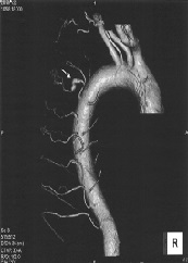 Coil Embolization for a Ruptured Intercostal Artery Aneurysm Complicated with Neurofibromatosis Type 1