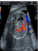 The Value of Five - Stage Combined Double - Aortic Arch Incision in Prenatal Screening of Low Risk Fetus