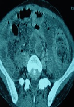 A Double Trichobezoar with a Gastric and Jejunal Locations: A Case Report
