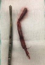 Case Report: Incidental finding of Retained Dilapan® found in a Woman Presenting with Perimenopausal Bleeding