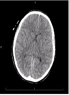 Cerebral Edema Treated Successfully after Liver Transplant in a Patient with Acute Iron Toxicity