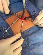 Sebaceous Umbilical Cyst: Infrequent Localization- A Case Report