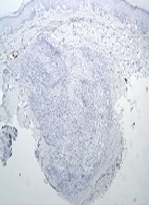 Solitary Pilar Leiomyoma of the Finger: A Case Report