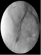 Endovascular Solution of a Post-Operative Iliofemoral Pseudo-Aneurysm: Case Report