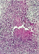 Tuberculosis in Children: Diagnosis of A Case Involving Isolated Lymphadenitis