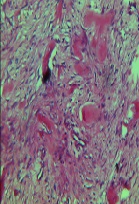 Desmoid Tumor in a Pregnant Woman: Case Report