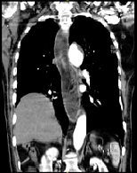 An Unusual Cause of Clubbing: The Esophageal Carcinoma