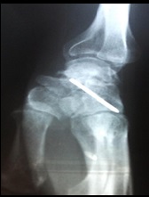 Bilateral Fenton's Syndrome: A Case Report and Literature Review