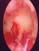 Role of Hysteroscopy and Endometrial Curettage in Postmenopausal Women with and Without Postmenopausal Bleeding