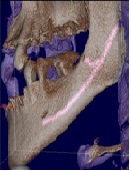 Trifid Mandibular Canal and Lingual Accessory Mental Foramen: A Case of Two Rare Anatomical Variations