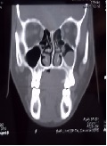 Juvenile Palatal Pleomorphic Adenoma with Mucous Retention Cyst: An Unusual Association